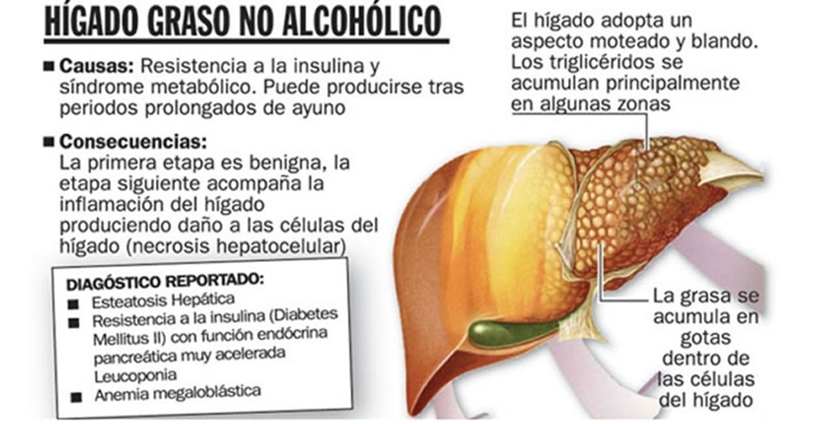 Hígado graso no alcohólico: una enfermedad silenciosa