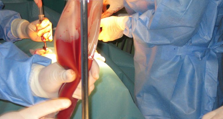 REDMO supera los 10.000 trasplantes de células madre sanguíneas